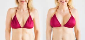 Before and after images of a woman who is happy to have received a breast lift at Chatham Plastic Surgery.