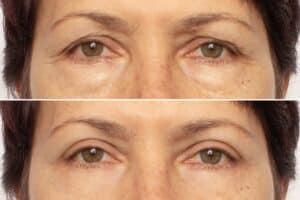 Before and after eyelid surgery in Savannah